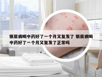 银屑病喝中药好了一个月又复发了 银屑病喝中药好了一个月又复发了正常吗