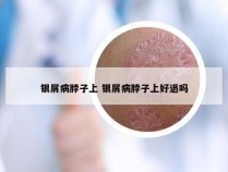 银屑病脖子上 银屑病脖子上好退吗