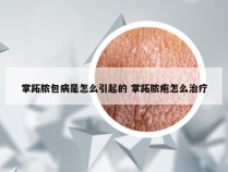 掌跖脓包病是怎么引起的 掌跖脓疱怎么治疗