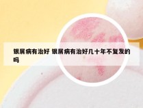 银屑病有治好 银屑病有治好几十年不复发的吗