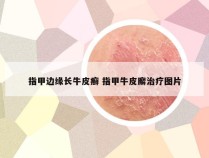 指甲边缘长牛皮癣 指甲牛皮廨治疗图片