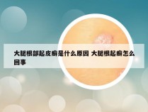 大腿根部起皮癣是什么原因 大腿根起癣怎么回事