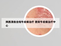 陕西渭南合阳牛皮癣治疗 西安牛皮癣治疗中心