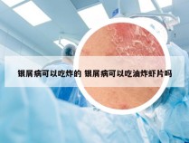 银屑病可以吃炸的 银屑病可以吃油炸虾片吗