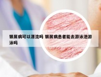 银屑病可以漂流吗 银屑病患者能去游泳池游泳吗