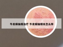 牛皮癣抽烟治疗 牛皮癣抽烟会怎么样