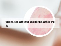 银屑病与荨麻疹区别 银屑病和荨麻疹哪个好治