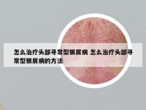 怎么治疗头部寻常型银屑病 怎么治疗头部寻常型银屑病的方法