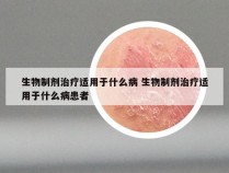 生物制剂治疗适用于什么病 生物制剂治疗适用于什么病患者