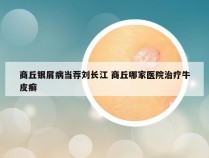 商丘银屑病当荐刘长江 商丘哪家医院治疗牛皮癣