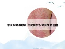 牛皮癣会要命吗 牛皮癣会不会有生命危险