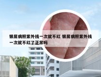 银屑病照紫外线一次就不红 银屑病照紫外线一次就不红了正常吗