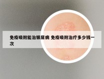 免疫吸附能治银屑病 免疫吸附治疗多少钱一次