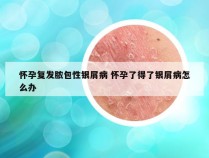怀孕复发脓包性银屑病 怀孕了得了银屑病怎么办