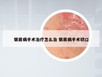 银屑病手术治疗怎么治 银屑病手术切口