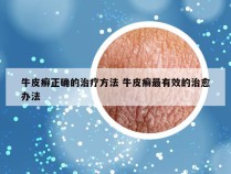 牛皮癣正确的治疗方法 牛皮癣最有效的治愈办法