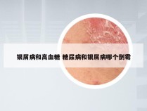 银屑病和高血糖 糖尿病和银屑病哪个倒霉
