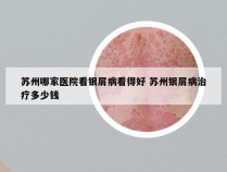 苏州哪家医院看银屑病看得好 苏州银屑病治疗多少钱