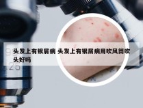 头发上有银屑病 头发上有银屑病用吹风筒吹头好吗