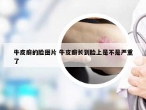 牛皮癣的脸图片 牛皮癣长到脸上是不是严重了