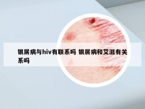 银屑病与hiv有联系吗 银屑病和艾滋有关系吗
