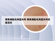 银屑病能吃海蜇头吗 银屑病能吃海蜇头吗百度百科