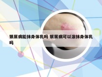 银屑病能抹身体乳吗 银屑病可以涂抹身体乳吗
