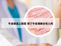 牛皮癣遇上新冠 得了牛皮病癣会死人吗