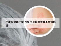 牛皮癣会跟一辈子吗 牛皮癣患者会不会得癌症