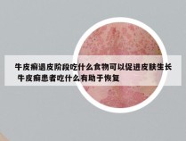 牛皮癣退皮阶段吃什么食物可以促进皮肤生长 牛皮癣患者吃什么有助于恢复