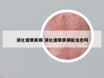 消化道银屑病 消化道银屑病能治愈吗