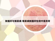 微循环与银屑病 银屑病微循环检测中度异常