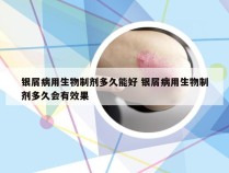 银屑病用生物制剂多久能好 银屑病用生物制剂多久会有效果