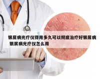 银屑病光疗仪得用多久可以彻底治疗好银屑病 银屑病光疗仪怎么用