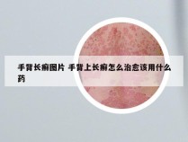 手背长癣图片 手背上长癣怎么治愈该用什么药
