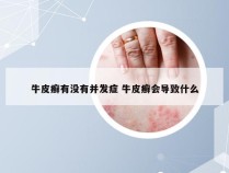 牛皮癣有没有并发症 牛皮癣会导致什么