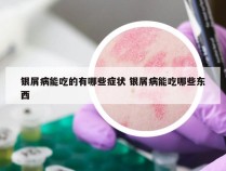 银屑病能吃的有哪些症状 银屑病能吃哪些东西
