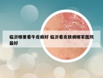 临沂哪里看牛皮癣好 临沂看皮肤病哪家医院最好
