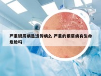 严重银屑病是遗传病么 严重的银屑病有生命危险吗