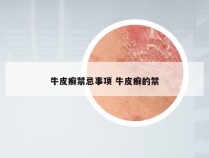 牛皮癣禁忌事项 牛皮癣的禁