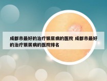 成都市最好的治疗银屑病的医院 成都市最好的治疗银屑病的医院排名