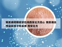 银屑病初期症状在线西安北方放心 银屑病会传染给孩子吗采用 西安北方