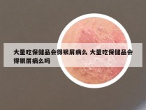 大量吃保健品会得银屑病么 大量吃保健品会得银屑病么吗