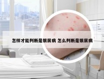 怎样才能判断是银屑病 怎么判断是银屑病