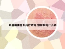 银屑癣用什么药疗效好 银屑癣吃什么药