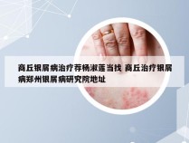 商丘银屑病治疗荐杨淑莲当找 商丘治疗银屑病郑州银屑病研究院地址