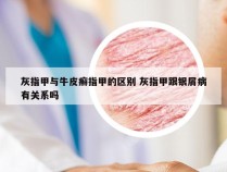 灰指甲与牛皮癣指甲的区别 灰指甲跟银屑病有关系吗