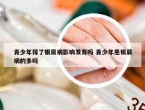 青少年得了银屑病影响发育吗 青少年患银屑病的多吗