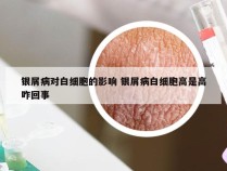 银屑病对白细胞的影响 银屑病白细胞高是高咋回事