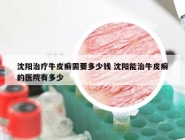 沈阳治疗牛皮癣需要多少钱 沈阳能治牛皮癣的医院有多少